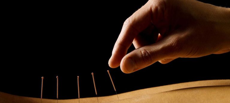 acupuncturedryneedling